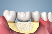 Bone Atrophy Around Implant Corrected with Grafting